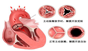 什么是主动脉瓣关闭不全?