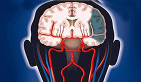 脑梗：出现4个症状，最好到医院做脑CT，不拖延