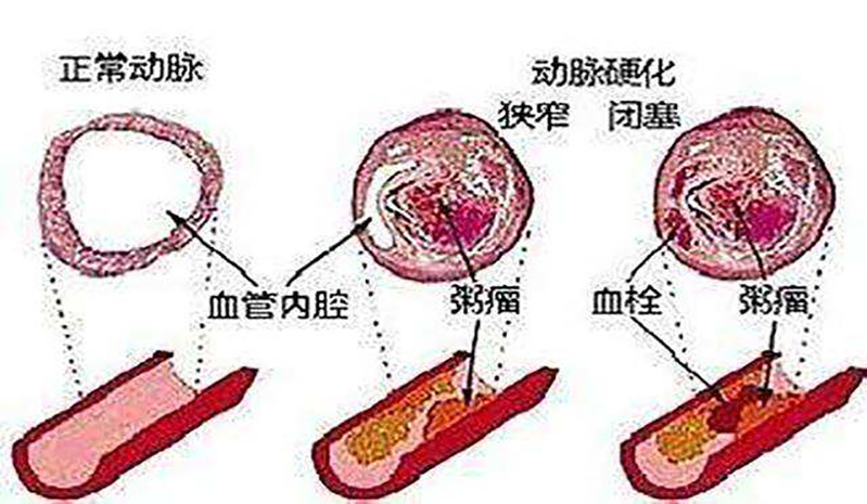 动脉粥样硬化是如何形成的？有哪些风险因素？