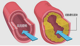 如何防止动脉硬化？